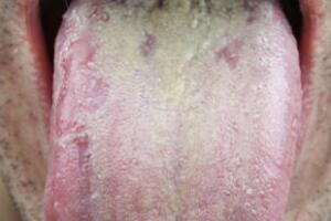 lingua-branca-causas-3.jpg