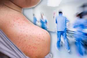 sacramento sarampión.jpg