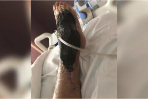 muere persona bacteria come carne Florida