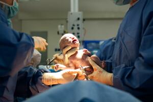 Baby being born via Caesarean Section