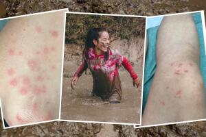 Alerta de salud tras Carrera Tough Mudder en Sonoma: Síntomas de erupciones cutáneas y fiebre preocupan a participantes. Autoridades investigan infecciones bacterianas.



