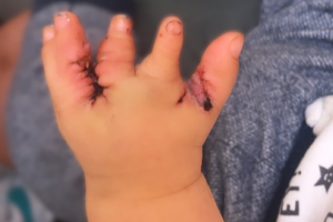 Su primera cirugía fue a los 11 meses de nacido