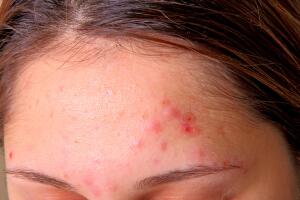 acne-espinha-1400-1000-0117.jpg