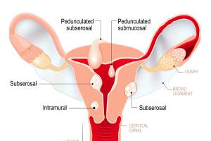 Síntomas de miomas o fibromas uterinos