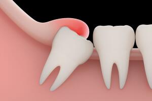 dente-do-siso-0817-1400x800.jpg