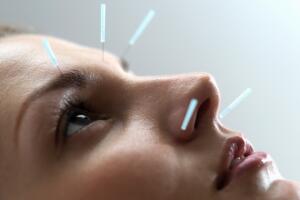 acupuntura-para-la-belleza-1.jpg