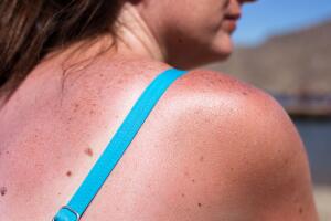 mancha-pele-sol-0519-1400x800.jpg