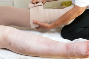 edema-nas-pernas-0716-630x350.png