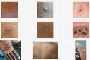 síntomas viruela mono contagia