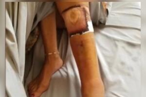 bacteria come carne/HERIDABACTERIA.jpeg