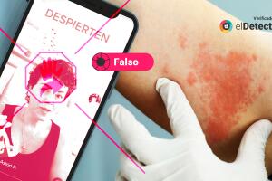 falso video tiktok herpes zoster