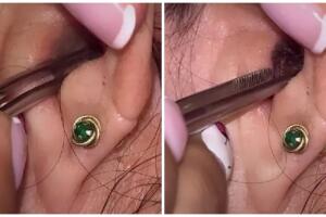 Joven descubre insecto en su oreja.