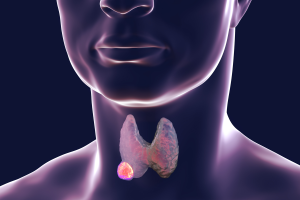 cancer-de-tireoide-0617-1400x800.png