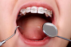 dentes-aparelho-dentista.jpg