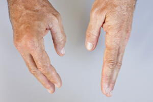 qué-es-el-lupus.jpg-2.jpg