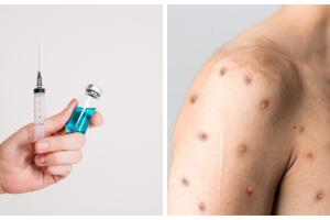 Vacuna contra viruela del mono