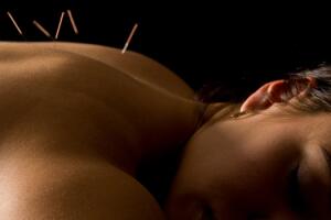 acupuntura-agulha-costas-0716-630x350.jpg