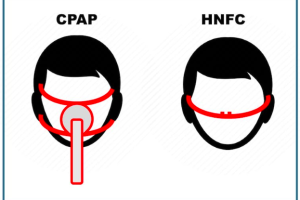 CPAP y HNFC.