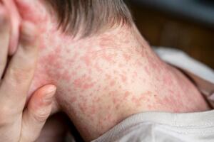 Alertan por posible exposición al sarampión en el aeropuerto de Newark.