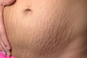 estrias-barriga-0117-1400x800.jpg