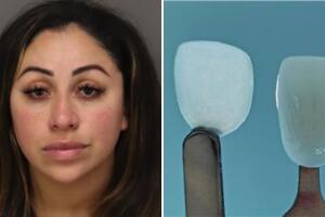 La Asociación Dental Americana advierte que carillas de personas no certificadas pueden causar daños graves.