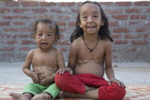 doenca-rara-benjamin-button-1.jpg