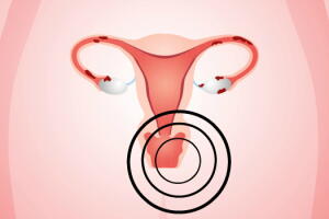 cancer-de-colo-de-utero-2.jpg