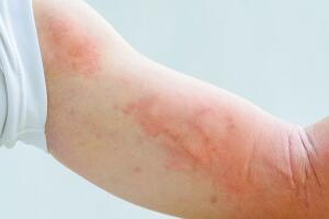 urticaria-braco-coceira-1217-1400x800.jpg