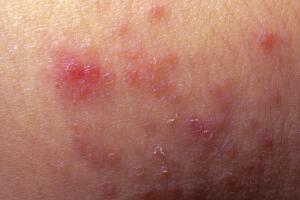 Sintomas-de-la-psoriasis4.jpg