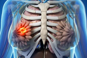 cancer-de-mama-0916-1400x800.jpg