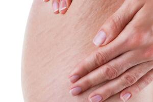 Stretch marks and cellulite