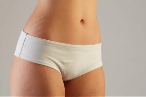estrias-barriga-coxa-1217-1400x800.jpg