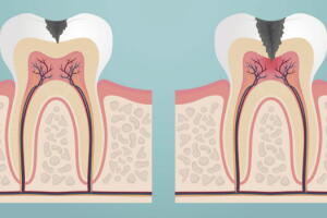 dentes-desgastados-1.jpg