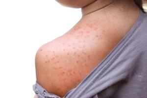 El sarampión es una enfermedad viral extremadamente contagiosa