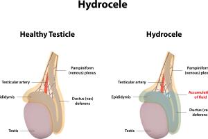 hidrocele.jpg