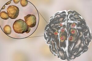 meningite-cerebro-0617-1400x800.jpg