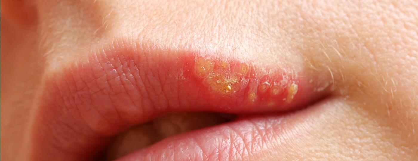 etapas de herpes labial