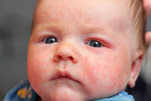 bebe-com-eczema.png