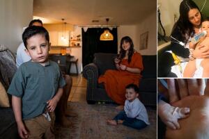 A los 18 meses, Tobias Lugo se sometió a una cirugía de segunda mano, que separó su dedo anular y meñique, en Banner-University Medical Center Phoenix. Tuvo que usar un yeso para esta cirugía porque era mayor. 