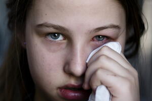 Que-es-la-conjuntivitis-2.jpg