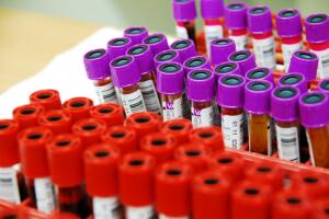 Entenda o resultado de exame de Aids