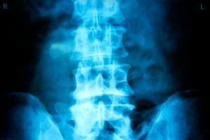 Ozonoterapia-discal2.jpg
