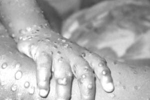 Viruela del mono.jpg