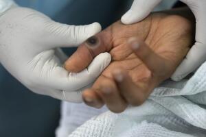 Monkeypox