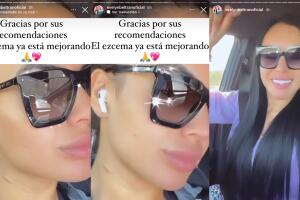 Evelyn Beltrán mostró los eczemas que le salieron en el cuello.