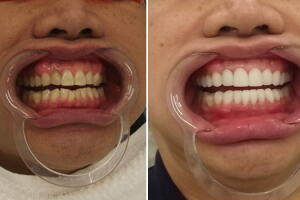 meu-dente-quebrou-antes-depois.jpg