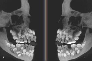 Niña de 11 años con 81 dientes y su caso se hace viral (4).jpg