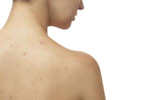 Young girl with skin problem (acne) on the back
