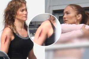 Jennifer López y Ben Affleck: la cantante aparece con una horrible herida en el brazo