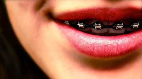 colores de brackets para hombre